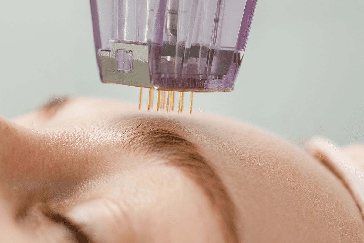 closeup of woman receiving microneedling treatment on her face